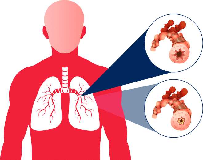 person with lung conditions